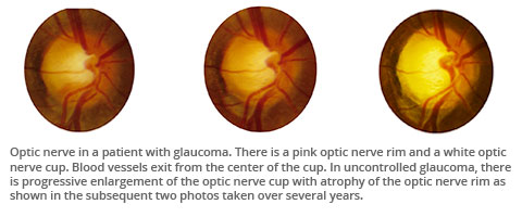 Optic nerve in a glaucoma patient